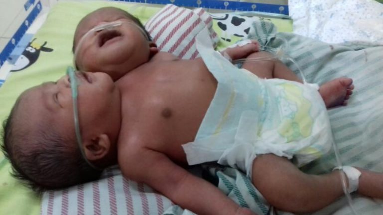 Kasihan! Bayi Pisahkan Bayi Kembar Siam Sulit Dipisahkan