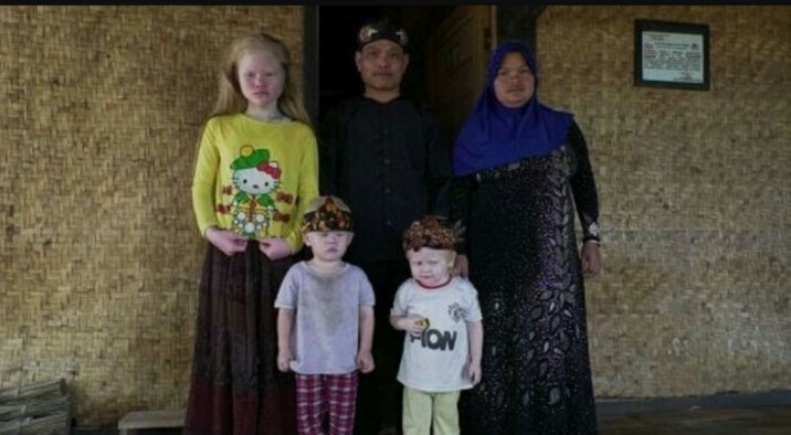 Warga di Kampung Albino Bogor Berisiko Idap Kanker