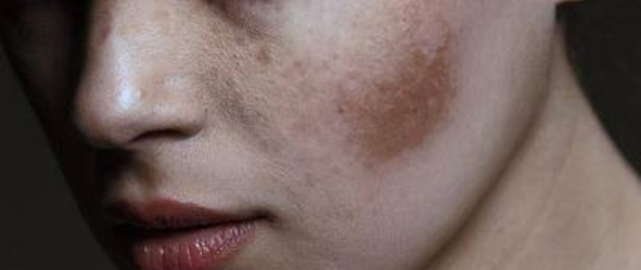 Akibat Skincare Abal-abal, Wajahku Hancur dan Melepuh