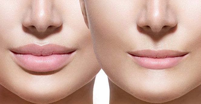 
 Cara Mengecilkan Bibir Secara Alami Tanpa Operasi. (blogelevenia/Bogordaily.net)