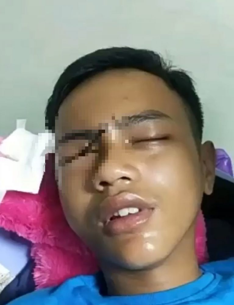 Kena Ketapel Nyasar, Mata Kanan Remaja di Makassar Jadi Korban