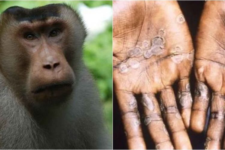 Waspada! Kasus Cacar Monyet Bisa Tertular dari Aktivitas Seks Sesama Jenis