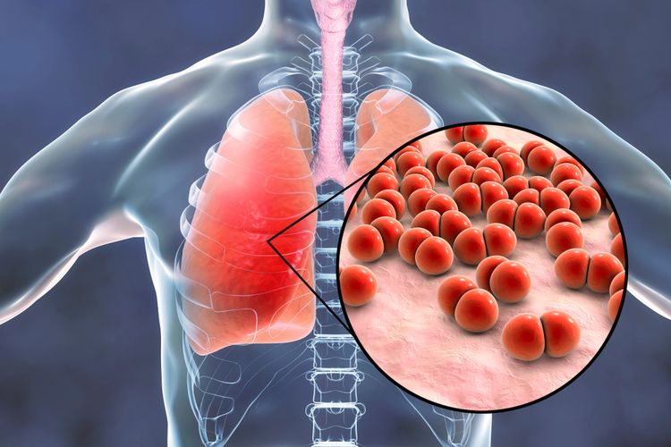 Mengenal Penyebab, Gejala dan Cara Pengobatan Pneumonia