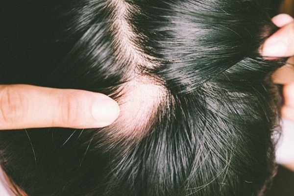Kenali Gejala Alopecia Areata Penyakit yang Menyebabkan Kebotakan Pada Rambut
