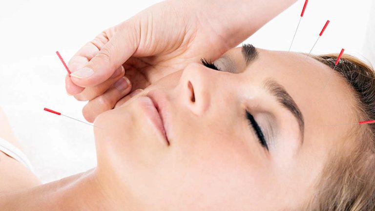 6 Manfaat Akupuntur, Atasi Sakit Kepala hingga Nyeri Punggung