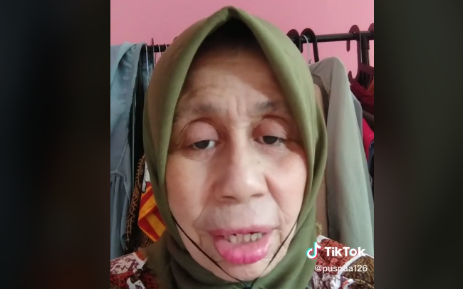 Viral, Wanita Usia 28 Tahun Dikira Nenek-Nenek Gegara Penyakit Langka