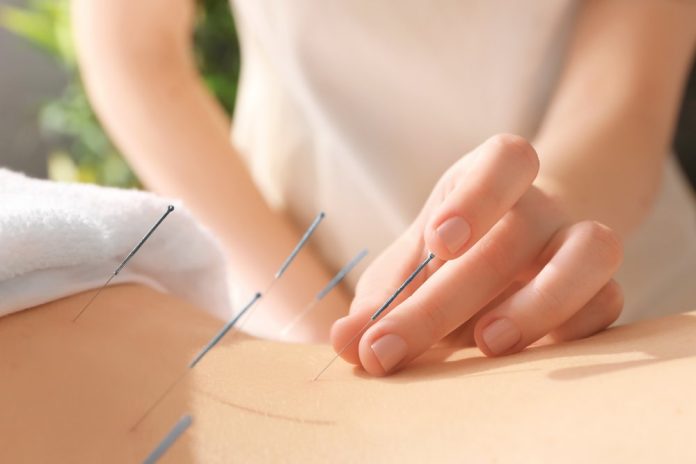 Akupunktur Jarum
