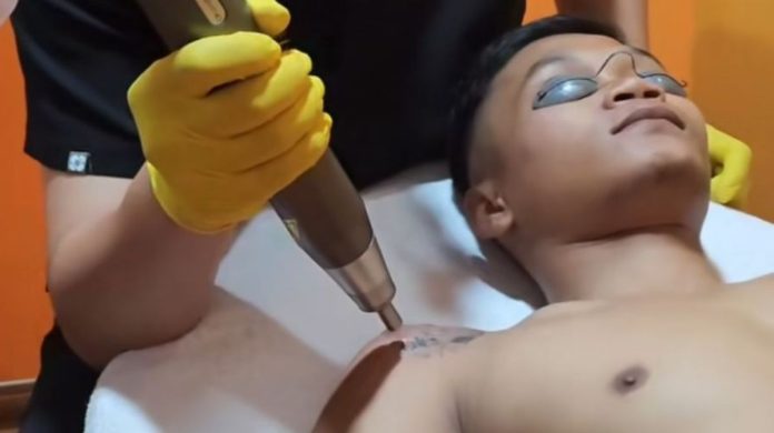 RA Clinic Bogor Menyediakan Treatment Laser Removal untuk Menghapus Tatto