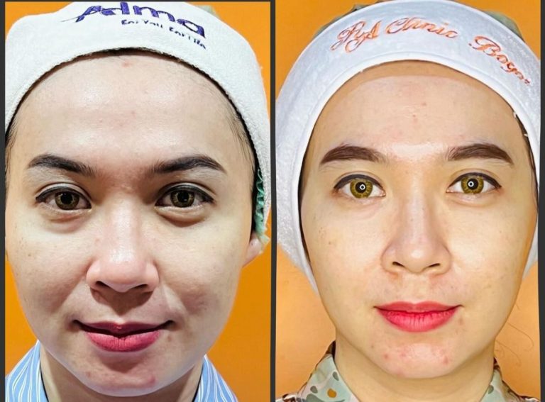 Kecilkan Rahang Tanpa Rasa Sakit, RA Clinic Bogor Hadirkan Treatment Alma Face Contour