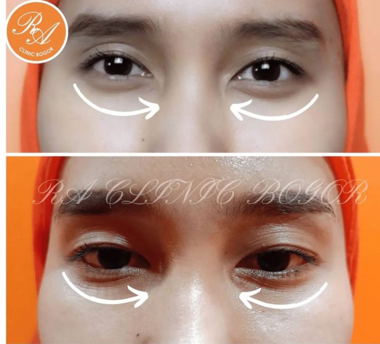 Rahasia Mata Cerah dan Segar: Treatment Eye Hollow Correction di RA Clinic Bogor