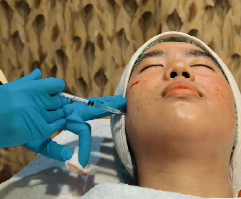 Atasi Jerawat, Treatment Skin Booster Acne Shine di RA Clinic Bogor
