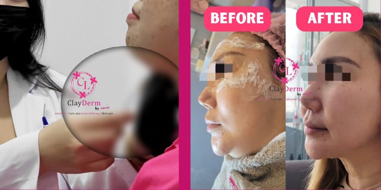ClayDerm Aesthetic Clinic Bogor: Solusi Efektif untuk Mengatasi Double Chin