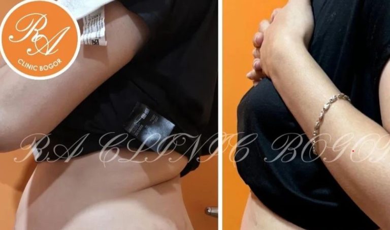 RA Clinic Bogor Tawarkan Treatment Langsing Tanpa Jarum Suntik dengan Alma Body Contour