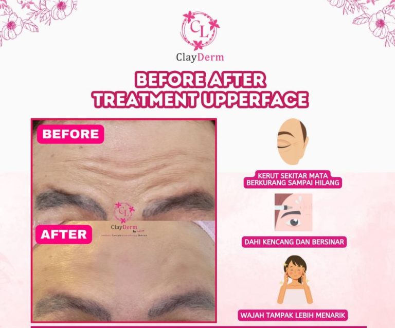 Wajah Lebih Fresh dan Menarik dengan Treatment Upperface di ClayDerm Aesthetic Clinic