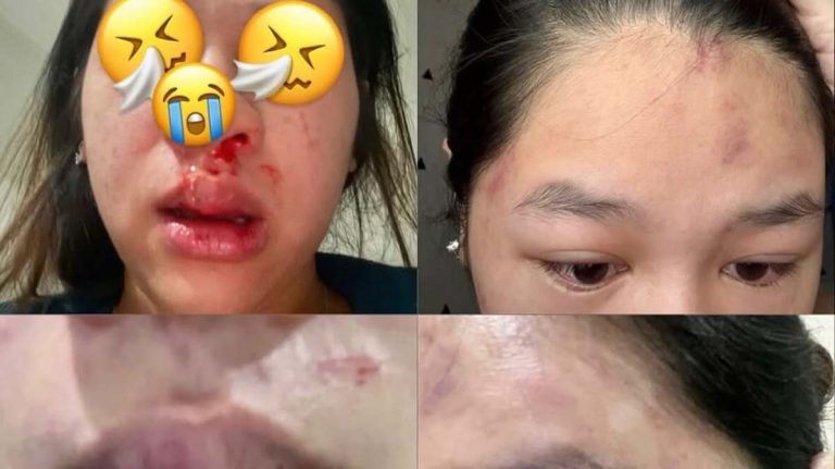 Viral, Ibu Muda di Bogor Jadi Korban KDRT,  Dihajar Suami Sampai Babak Belur