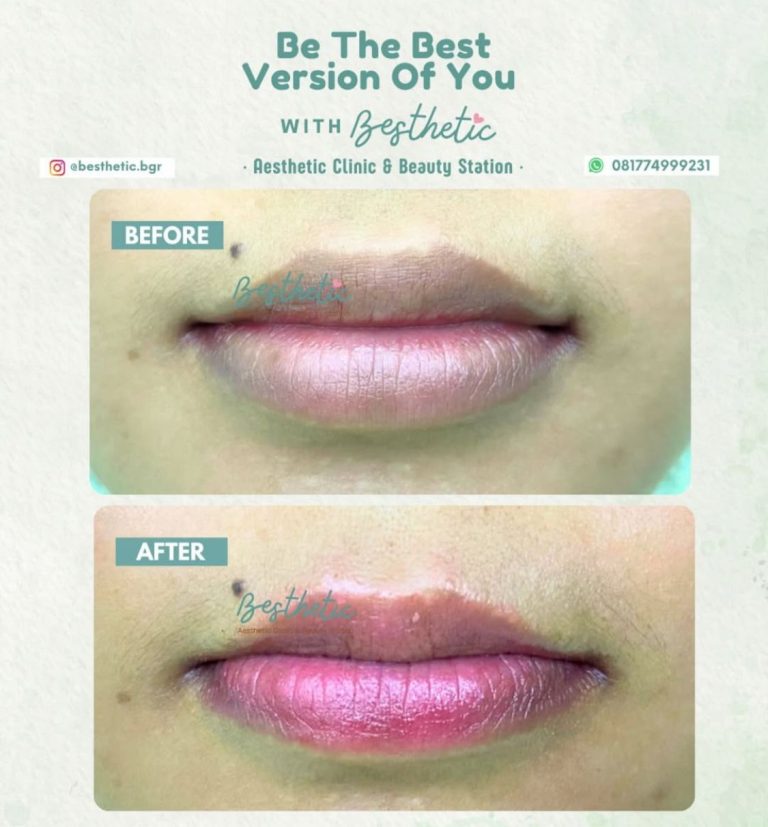 Atasi Masalah Bibir Gelap dan Kering, Besthetic Clinic Bogor Hadirkan Treatment Lip Laser + Lipcare