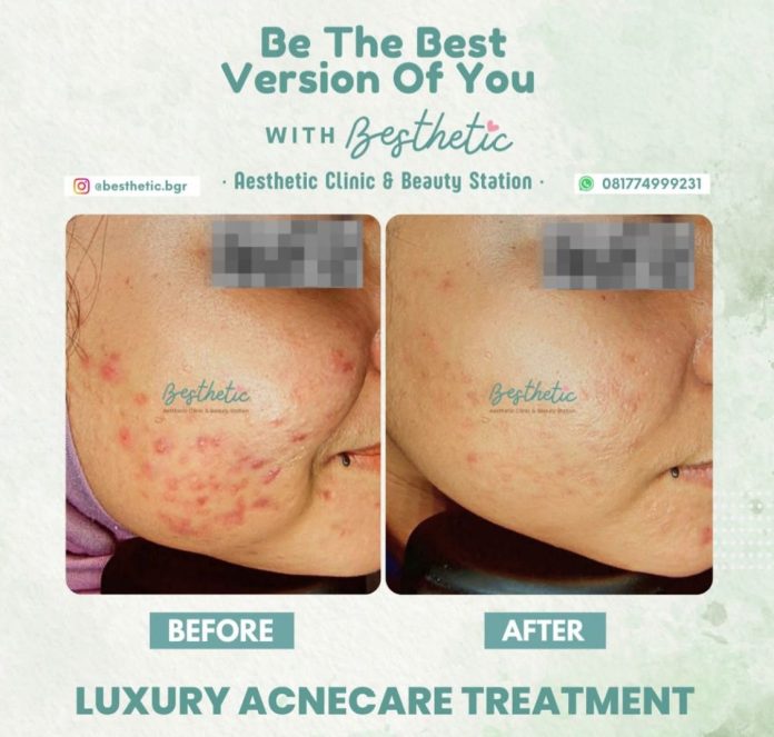 Luxury Acnecare Treatment