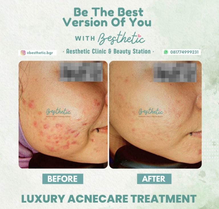 Luxury Acnecare Treatment