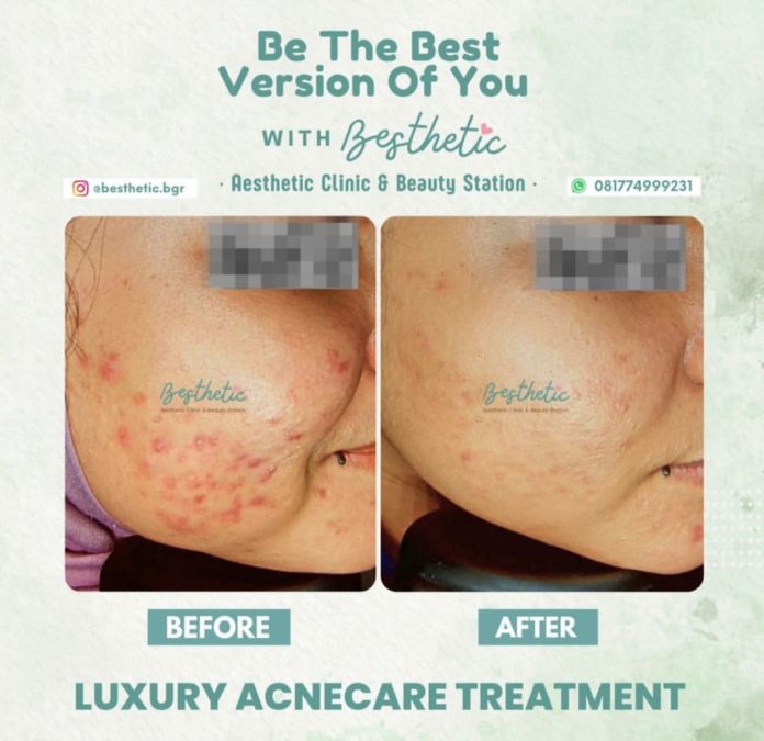 Luxury Acnecare Treatment Besthetic