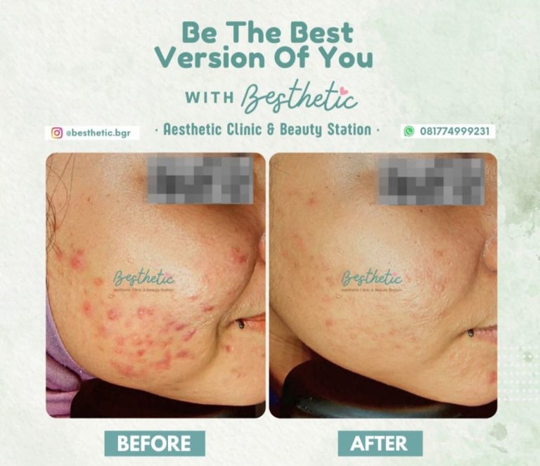 Radiance Acnecare Besthetic Clinic Bogor, Solusi Ampuh Atasi Jerawat Membandel
